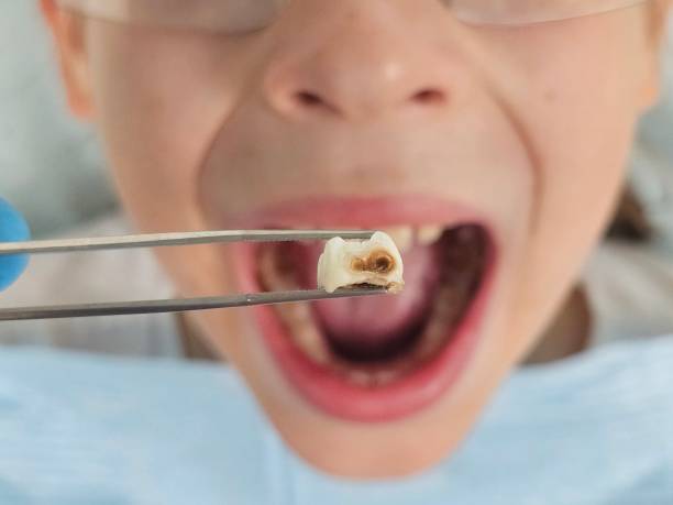 Best Chipped Tooth Repair Near Me  in North Newton, KS